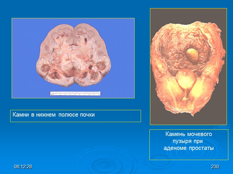 08:12:02 Камни в нижнем полюсе почки Камень мочевого пузыря при  аденоме простаты 230